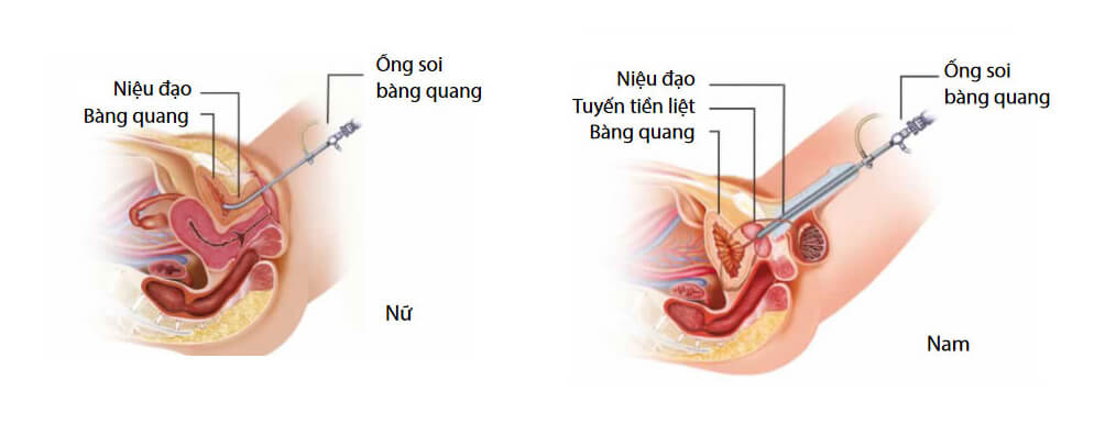 Hệ thống nội soi tiết niệu