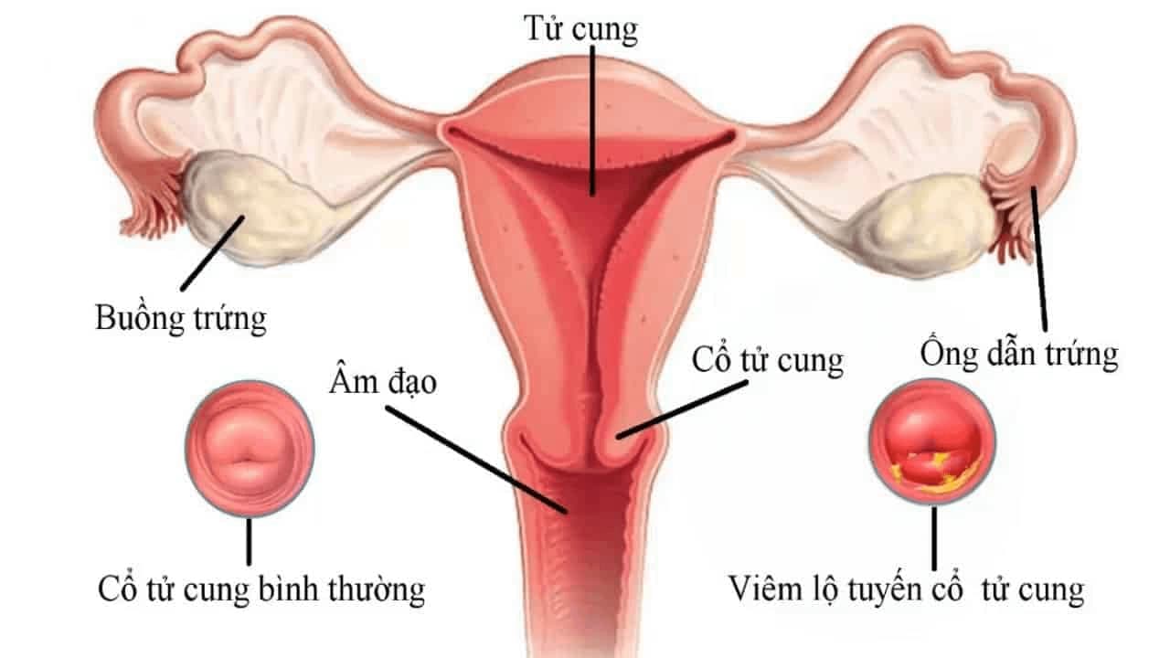 Áp lạnh cổ tử cung có ảnh hưởng gì đến sức khỏe không?