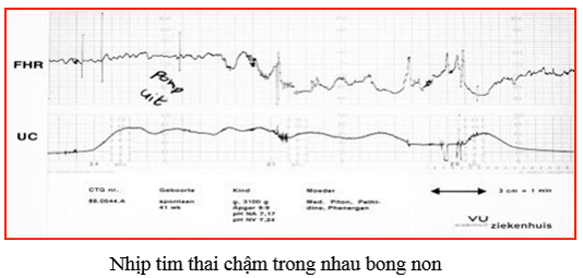 may nghe tim thai