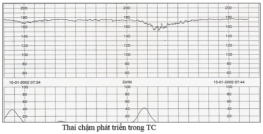 máy theo dõi tim thai