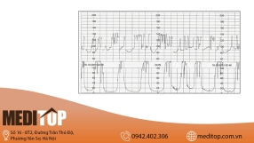 Giấy in monitor theo dõi sản khoa không thể thiếu trong theo dõi thai kỳ