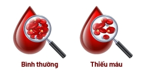 Những nguy cơ dẫn đến thiếu máu