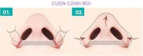 Thu hẹp cánh mũi