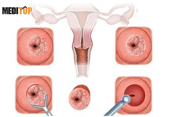 Viêm lộ tuyến cổ tử cung là bệnh lý phụ khoa thường gặp ở chị em phụ nữ