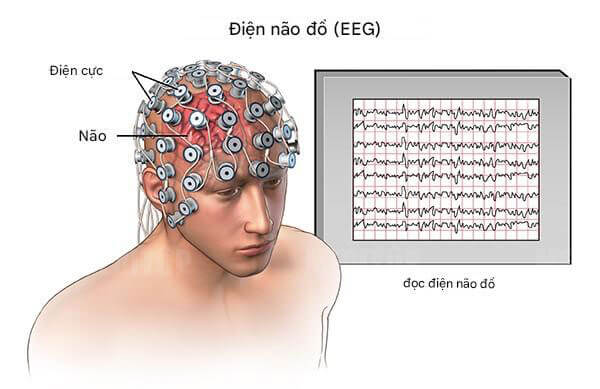 Điện não đồ thường quy