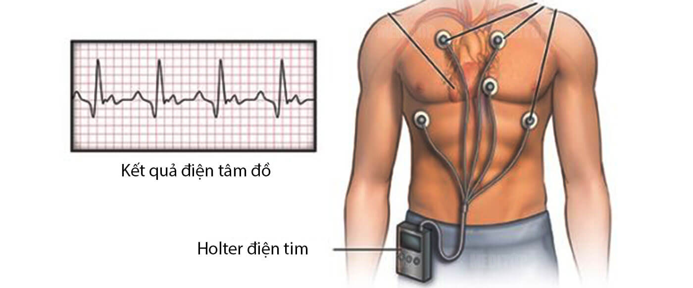 Tổng quan về phương pháp holter điện tim – huyết áp
