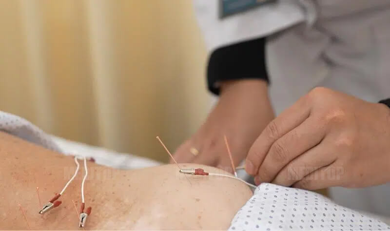 Giới thiệu chung về phương pháp điện châm