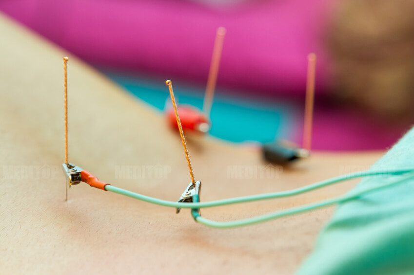 Máy điện châm mini dùng tại nhà