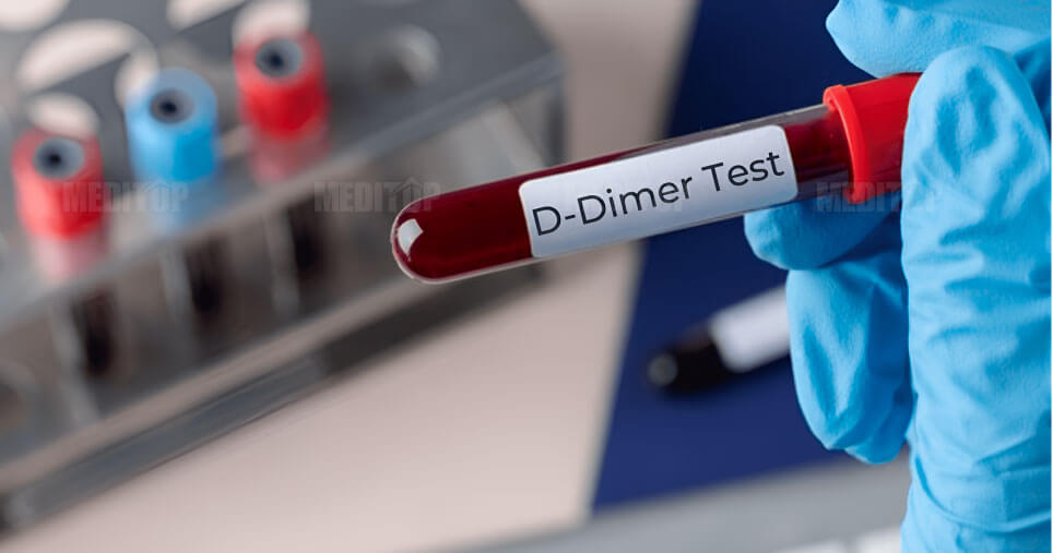 Định lượng D-Dimer