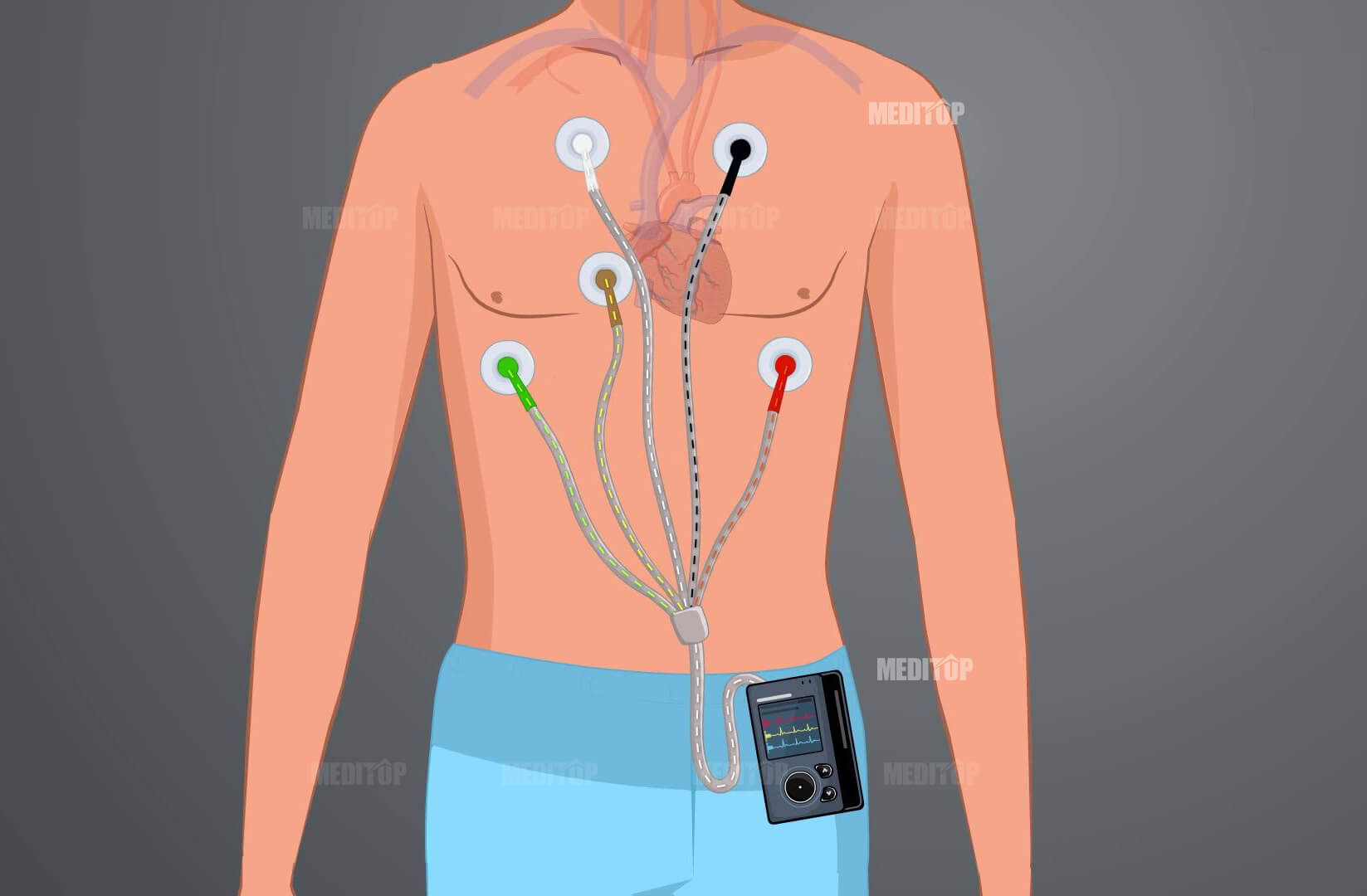 Hướng dẫn sử dụng Holter điện t&acirc;m đồ trong vận động