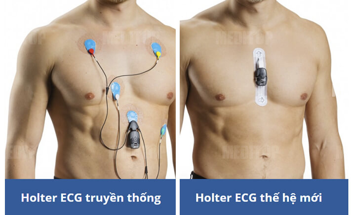 Sự kh&aacute;c biệt giữa điện t&acirc;m đồ thường v&agrave; holter điện t&acirc;m đồ