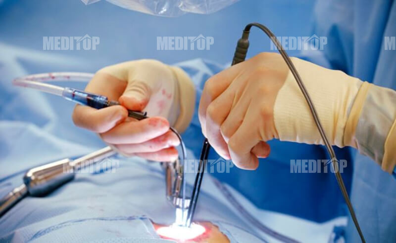 Theo dõi và kiểm soát khi dùng máy đốt sóng cao tần