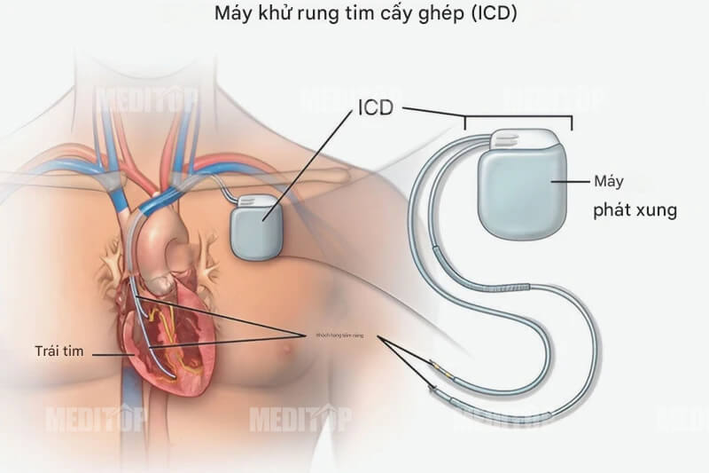 Ứng dụng lâm sàng của máy hỗ trợ tim
