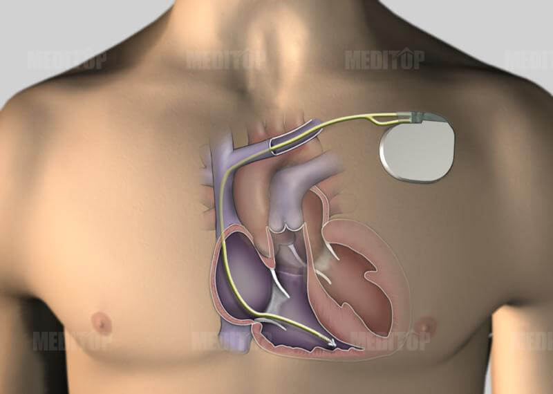 Quy trình phẫu thuật đặt máy trợ tim