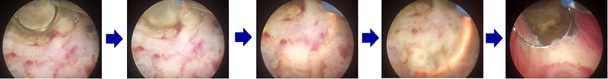 Các chế độ hoạt động của dao mổ ZEUS PRIME