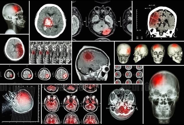 Chẩn đoán hình ảnh trong ung thư