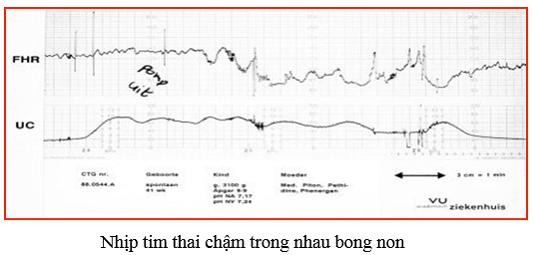 may nghe tim thai