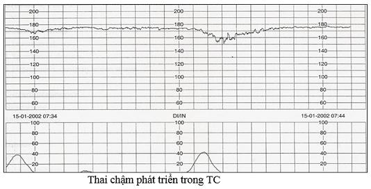 máy theo dõi tim thai