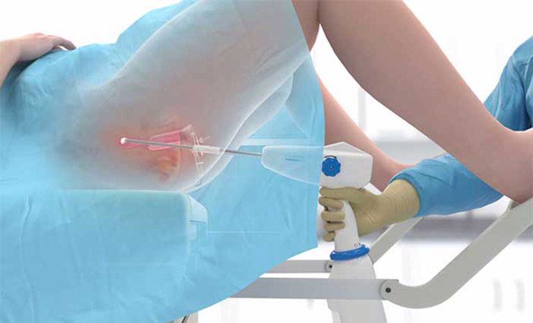 Ảnh hưởng của phương pháp áp lạnh cổ tử cung