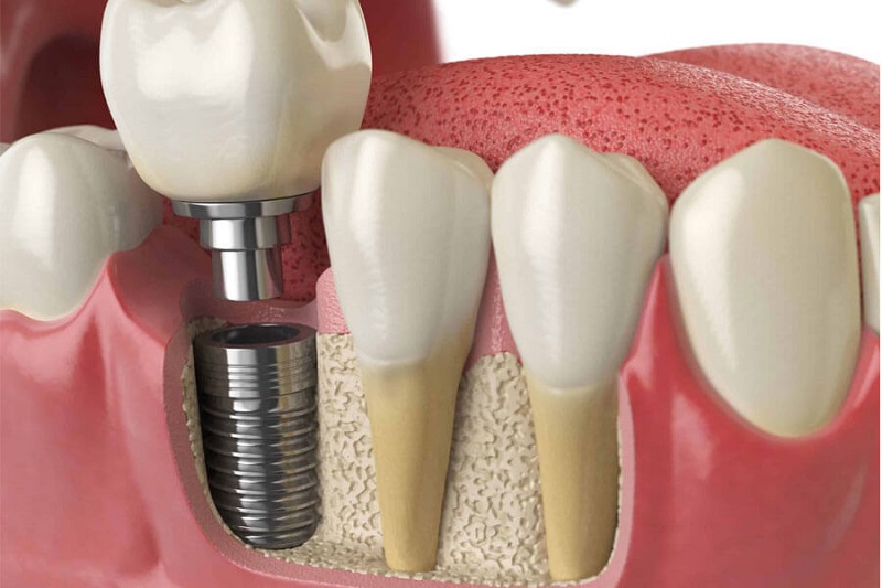 đặt Implant để phục hình răng.