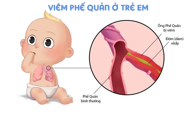Bệnh viêm thanh khí phế quản cấp có nguy hiểm không